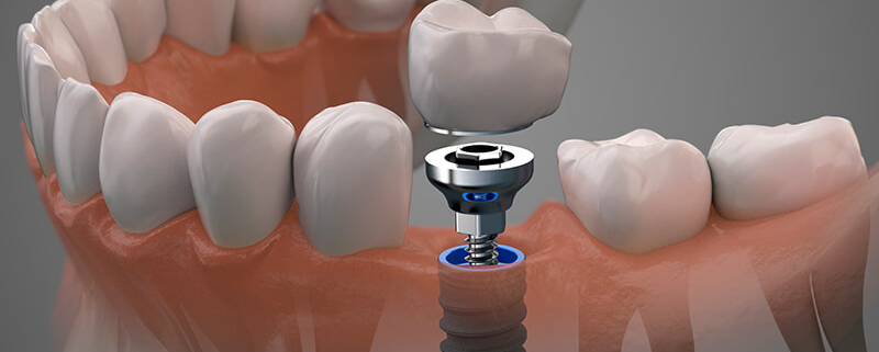 casos de erro odontológico